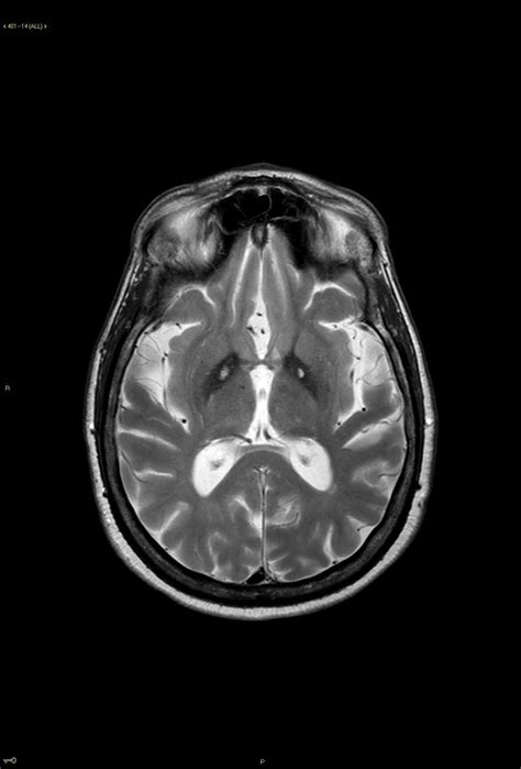 hallervorden-spatz disease